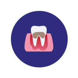 periodontitis avanzada