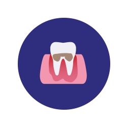 periodontitis